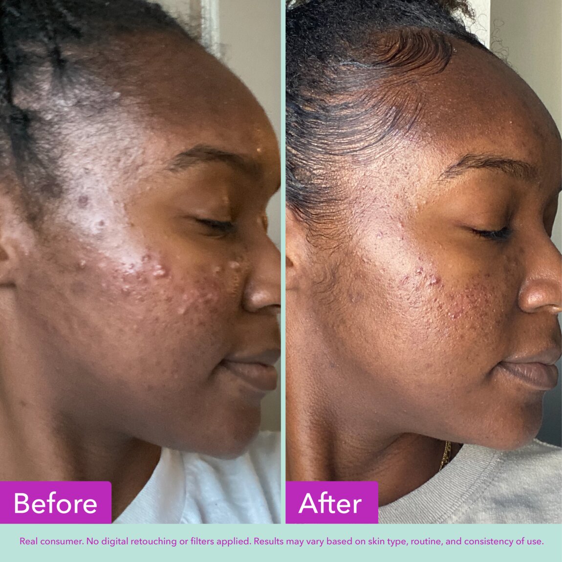 acne-foaming-cleanser-v9 zb_p.jpg